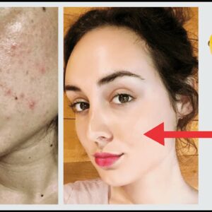 HOW TO HAVE SMOOTH AND ACNES-FREE SKIN! KOREAN RECIPE WITH ONLY 3 INGREDIENTS!